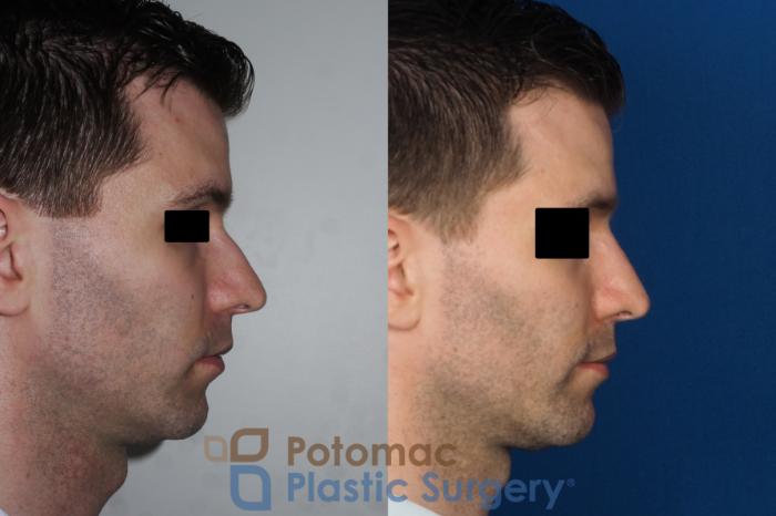 Before & After Rhinoplasty - Medical Case 226 Right Side View in Washington DC & Arlington , DC