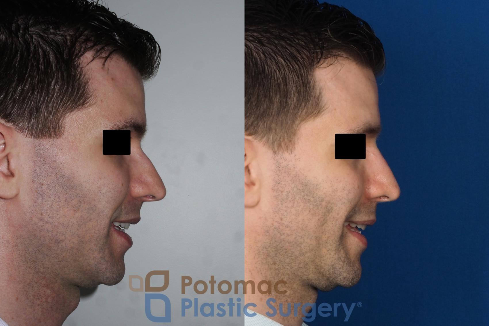 Before & After Rhinoplasty - Cosmetic Case 226 Right Side View #2 View in Washington, DC