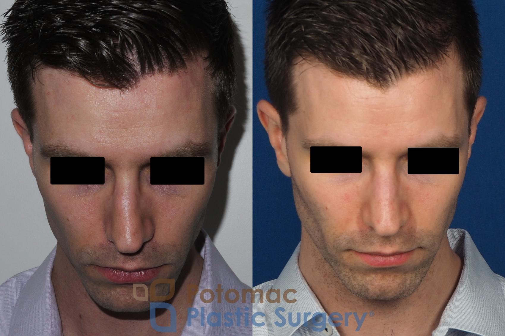 Before & After Rhinoplasty - Cosmetic Case 226 Top View in Washington, DC