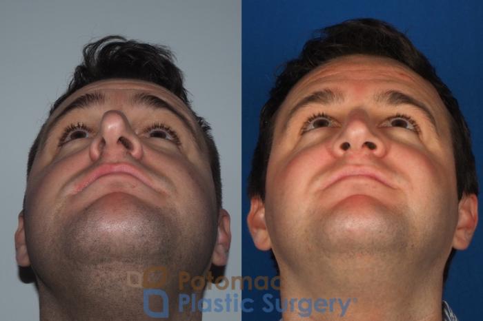 Before & After Rhinoplasty - Cosmetic Case 230 Bottom View in Washington, DC