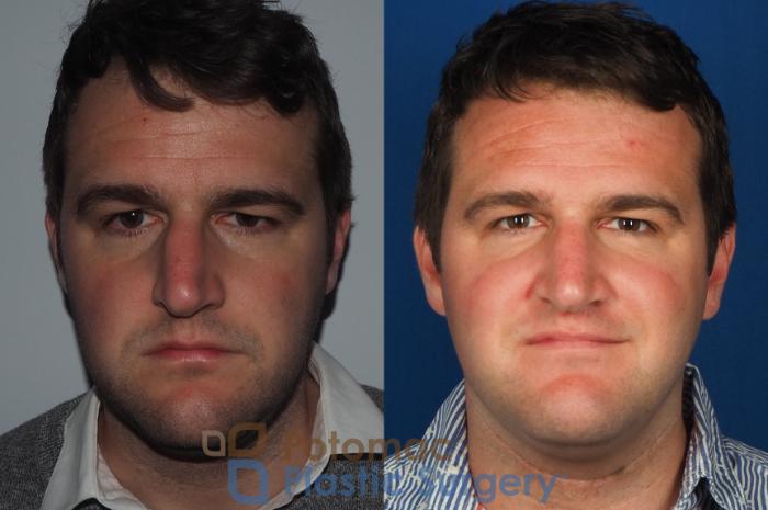 Before & After Rhinoplasty - Cosmetic Case 230 Front View in Washington, DC
