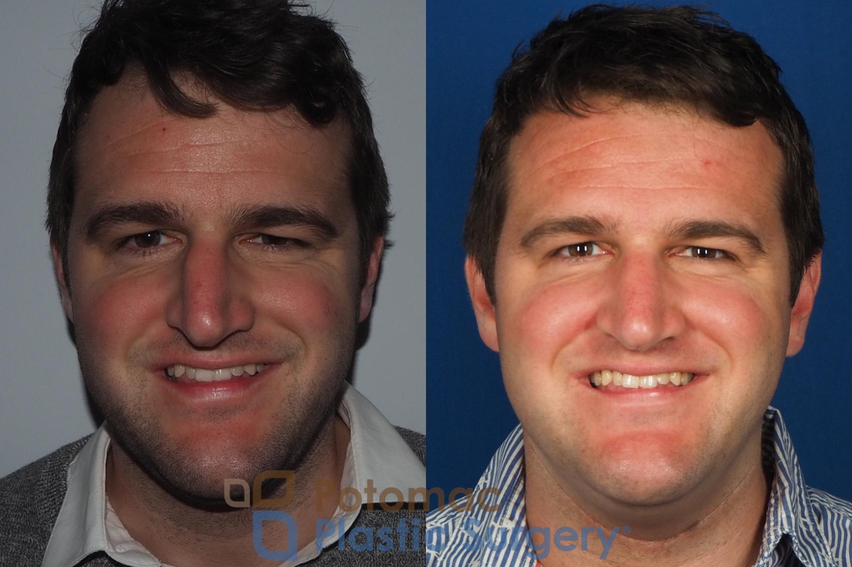 Before & After Rhinoplasty - Cosmetic Case 230 Front View #2 View in Washington, DC
