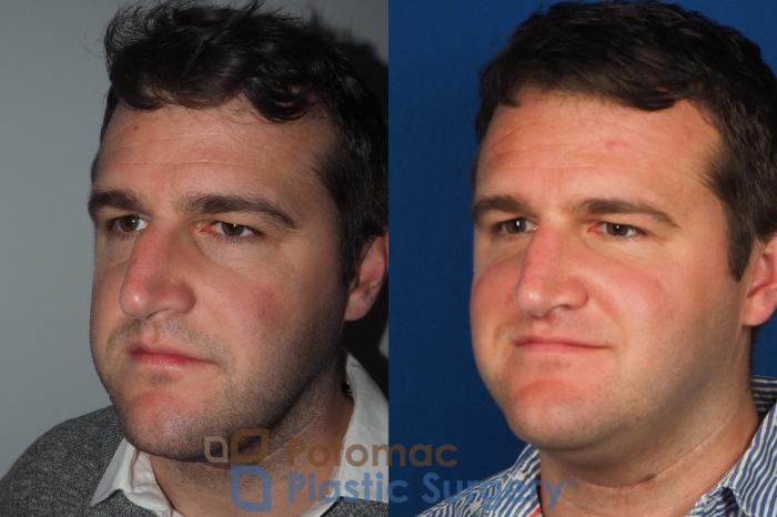 Before & After Rhinoplasty - Cosmetic Case 230 Left Oblique View in Washington, DC