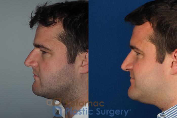 Before & After Rhinoplasty - Cosmetic Case 230 Left Side View in Washington, DC