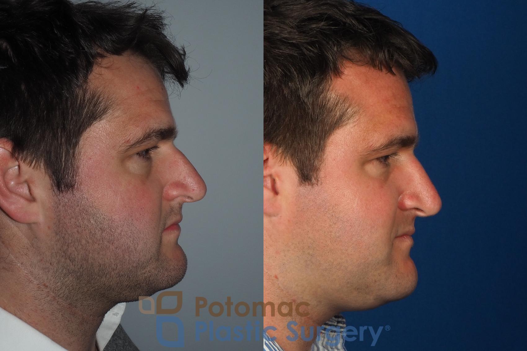 Before & After Rhinoplasty - Cosmetic Case 230 Right Side View in Washington, DC