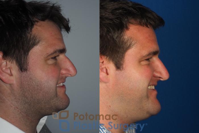 Before & After Rhinoplasty - Cosmetic Case 230 Right Side View #2 View in Washington, DC