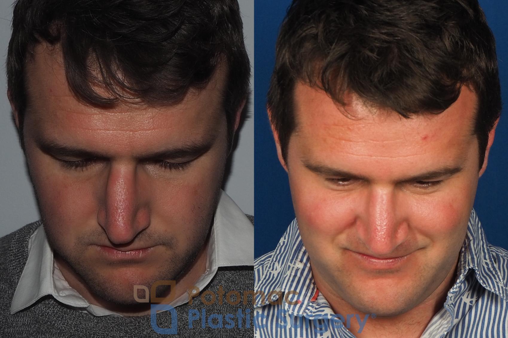 Before & After Rhinoplasty - Cosmetic Case 230 Top View in Washington, DC