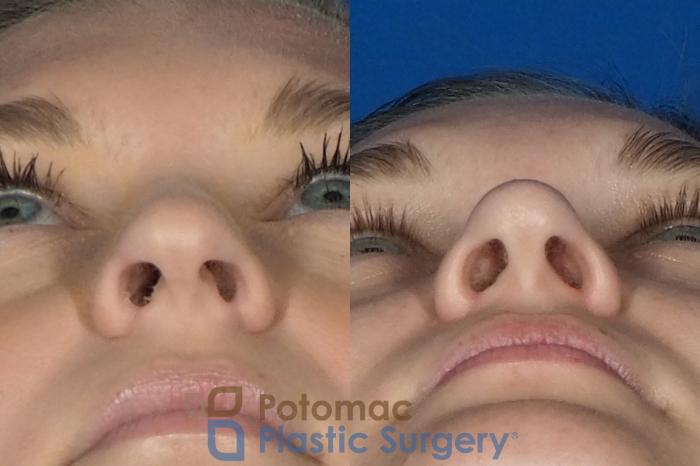 Before & After Rhinoplasty - Medical Case 235 Bottom View in Washington DC & Arlington , DC
