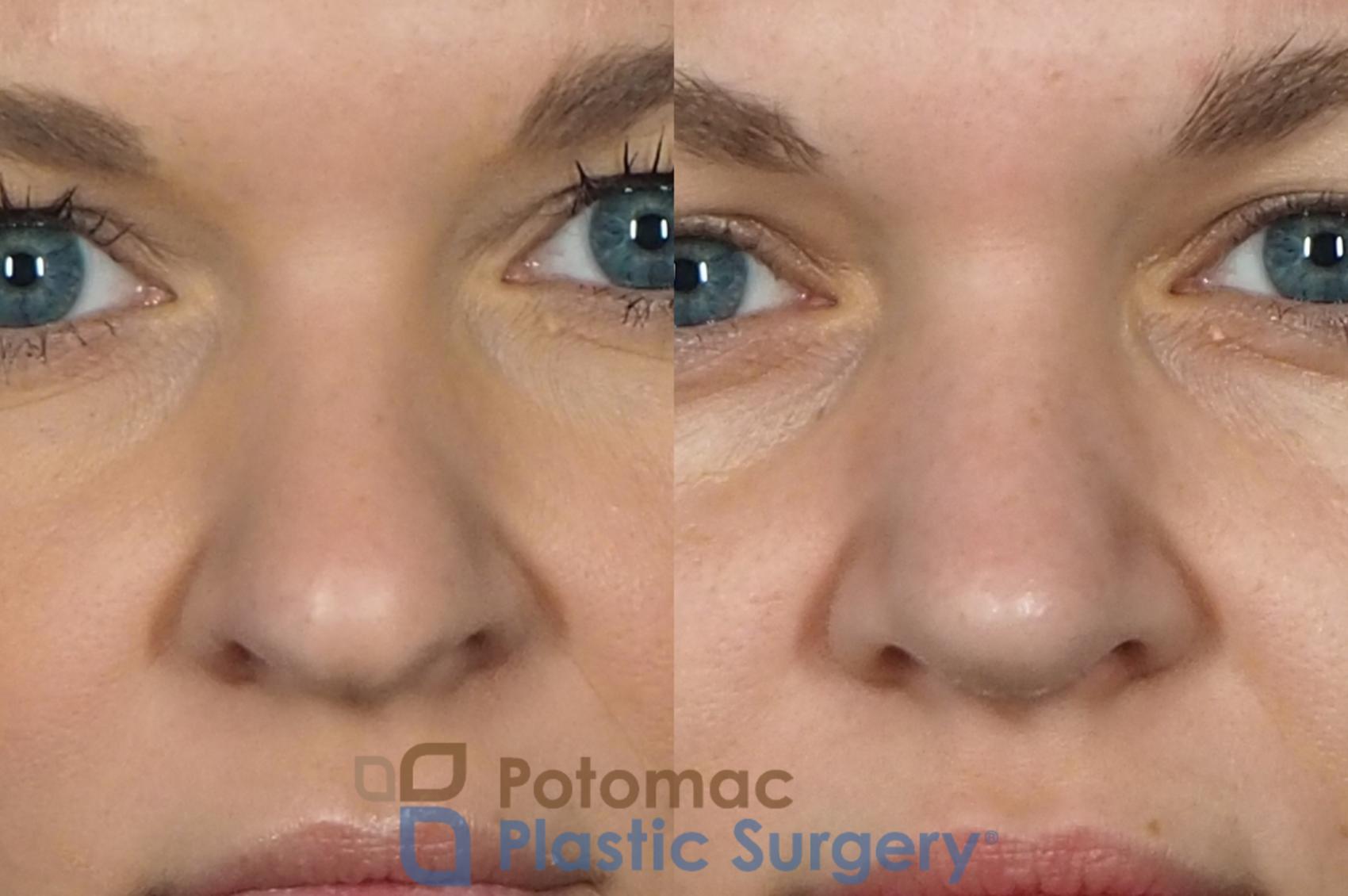 Before & After Rhinoplasty - Cosmetic Case 235 Front View in Washington DC & Arlington , DC