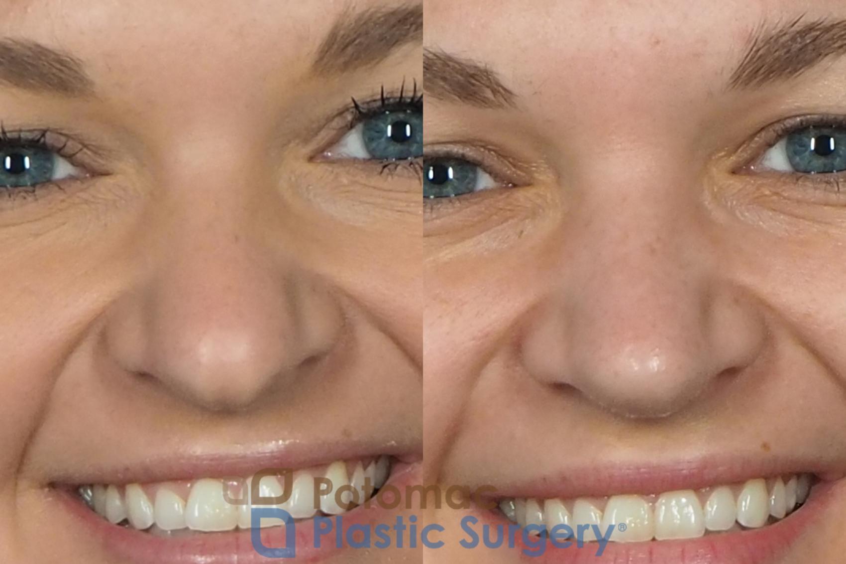 Before & After Rhinoplasty - Cosmetic Case 235 Front - Smiling View in Washington DC & Arlington , DC
