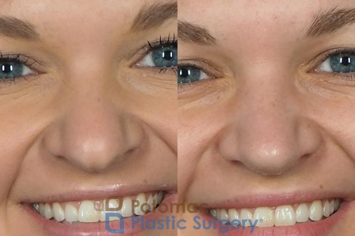 Before & After Rhinoplasty - Medical Case 235 Front - Smiling View in Washington DC & Arlington , DC