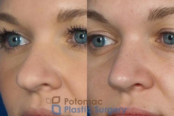 Before & After Rhinoplasty - Cosmetic Case 235 Left Oblique View in Arlington, VA & Washington, DC