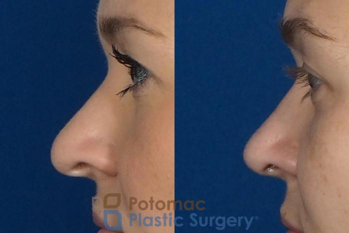Before & After Rhinoplasty - Cosmetic Case 235 Left Side View in Arlington, VA & Washington, DC
