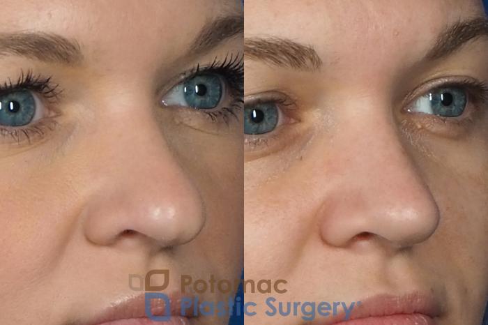 Before & After Rhinoplasty - Cosmetic Case 235 Right Oblique View in Arlington, VA & Washington, DC