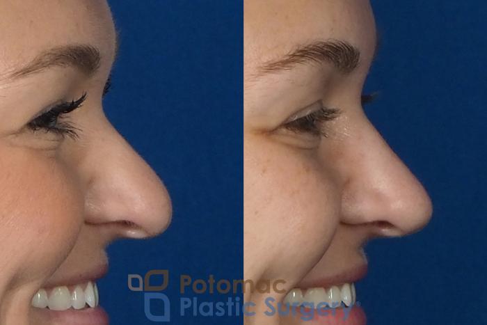 Before & After Rhinoplasty - Cosmetic Case 235 Right Side - Smiling View in Arlington, VA & Washington, DC