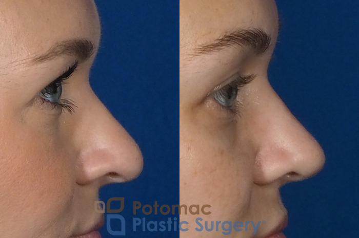 Before & After Rhinoplasty - Cosmetic Case 235 Right Side View in Arlington, VA & Washington, DC