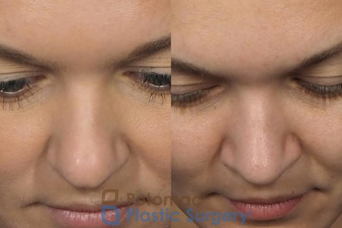Before & After Rhinoplasty - Cosmetic Case 235 Top View in Arlington, VA & Washington, DC