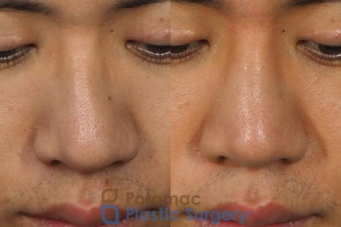 Before & After Rhinoplasty - Cosmetic Case 240 Above View in Washington DC & Arlington , DC