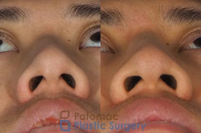 Before & After Rhinoplasty - Cosmetic Case 240 Below View in Washington DC & Arlington , DC