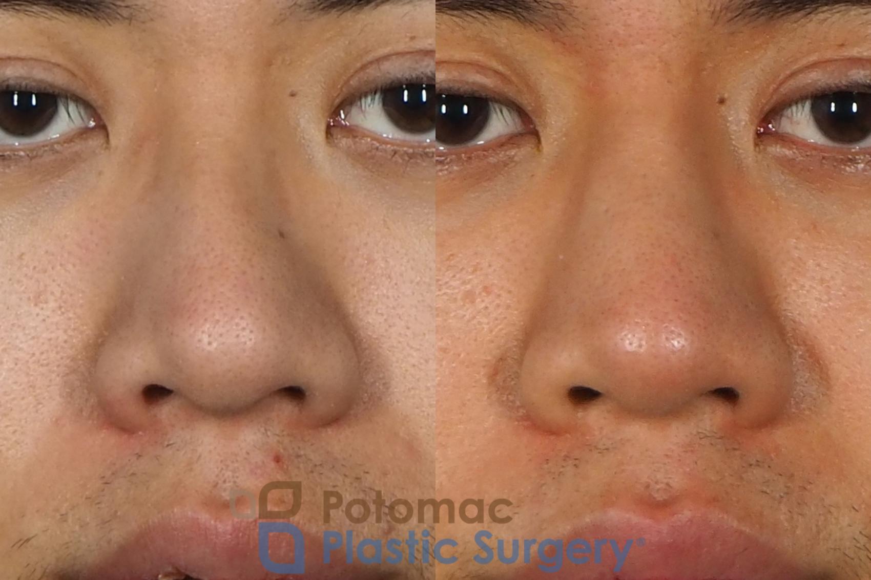 Before & After Rhinoplasty - Cosmetic Case 240 Front View #1 View in Washington DC & Arlington , DC