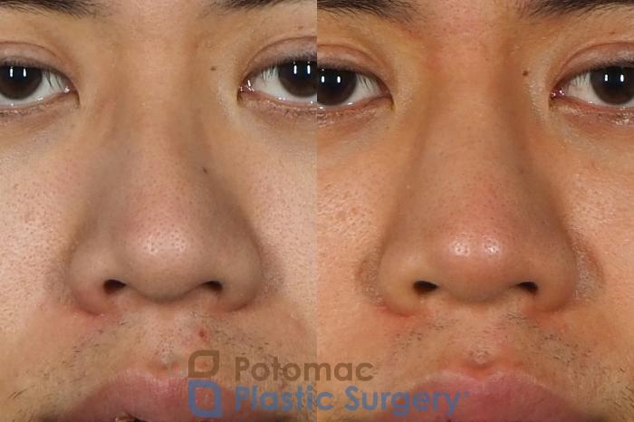Before & After Rhinoplasty - Cosmetic Case 240 Front View #1 View in Washington DC & Arlington , DC