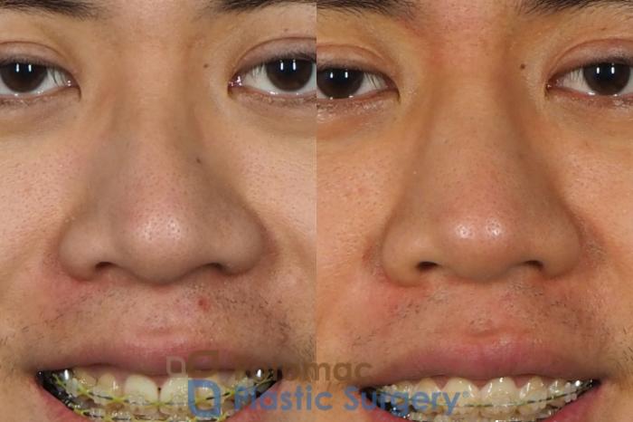Before & After Rhinoplasty - Cosmetic Case 240 Front View #2 View in Washington DC & Arlington , DC