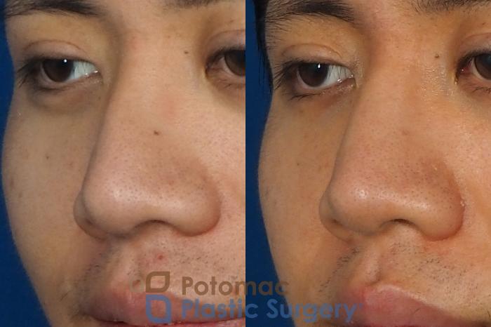 Before & After Rhinoplasty - Cosmetic Case 240 Left Oblique View in Washington DC & Arlington , DC