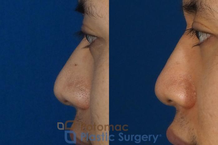 Before & After Rhinoplasty - Cosmetic Case 240 Left Side View in Washington DC & Arlington , DC