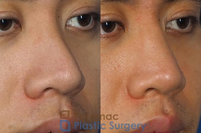 Before & After Rhinoplasty - Cosmetic Case 240 Right Oblique View in Washington DC & Arlington , DC