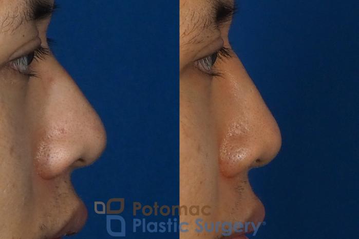 Before & After Rhinoplasty - Cosmetic Case 240 Right Side View in Washington DC & Arlington , DC