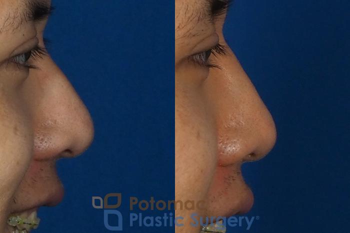 Before & After Rhinoplasty - Cosmetic Case 240 Right Side View #2 View in Washington DC & Arlington , DC
