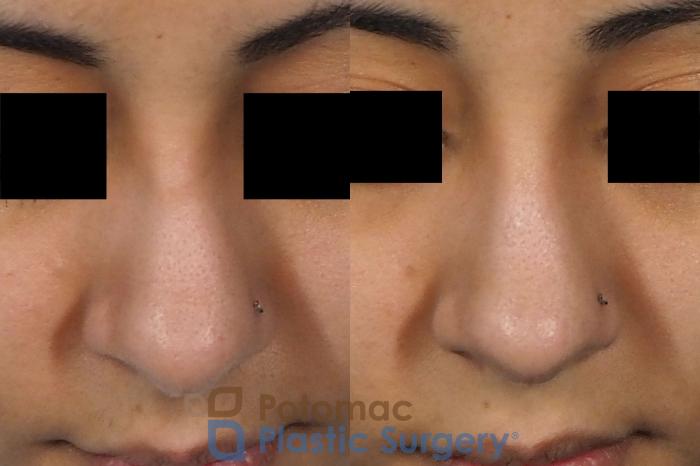 Before & After Rhinoplasty - Cosmetic Case 243 Above View in Washington DC & Arlington , DC