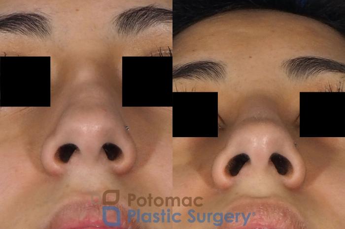 Before & After Rhinoplasty - Cosmetic Case 243 Below View in Washington DC & Arlington , DC