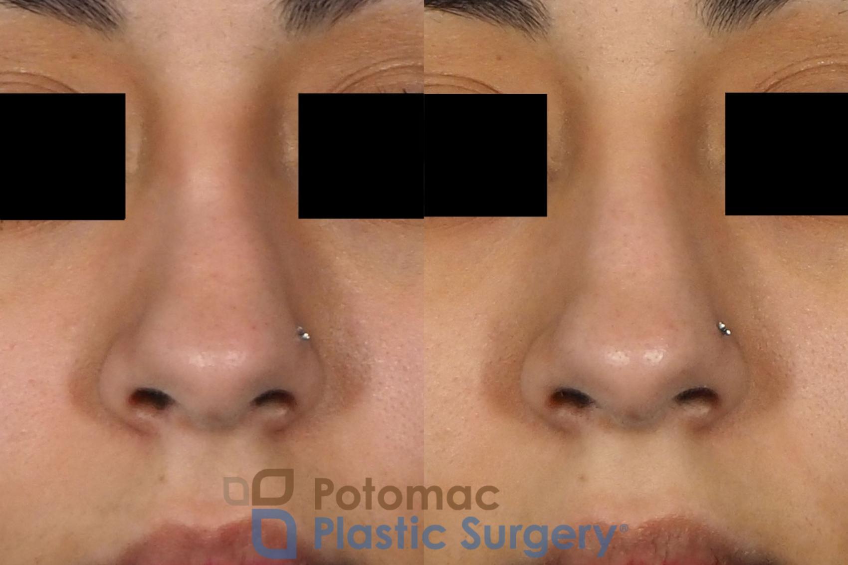Before & After Rhinoplasty - Cosmetic Case 243 Front View #1 View in Washington DC & Arlington , DC