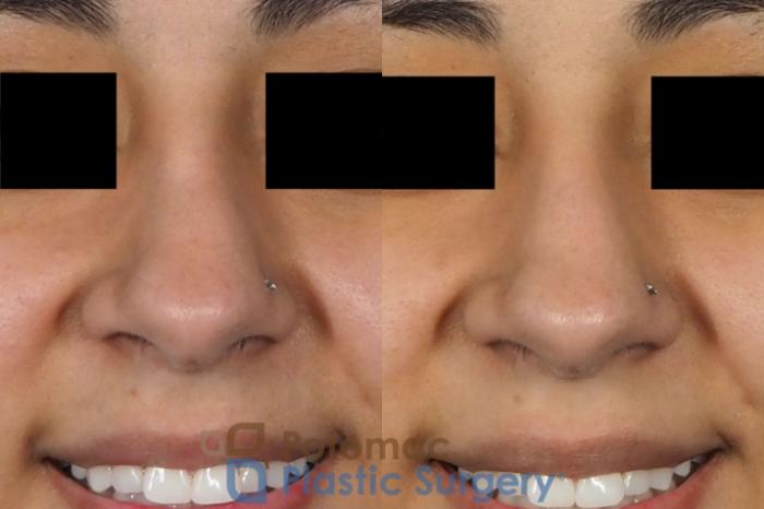 Before & After Rhinoplasty - Cosmetic Case 243 Front View #2 View in Washington DC & Arlington , DC