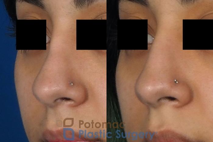 Before & After Rhinoplasty - Cosmetic Case 243 Left Oblique View in Washington DC & Arlington , DC