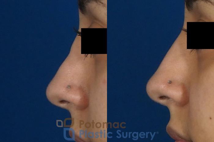 Before & After Rhinoplasty - Cosmetic Case 243 Left Side View in Washington DC & Arlington , DC