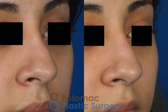 Before & After Rhinoplasty - Cosmetic Case 243 Right Oblique View in Washington DC & Arlington , DC