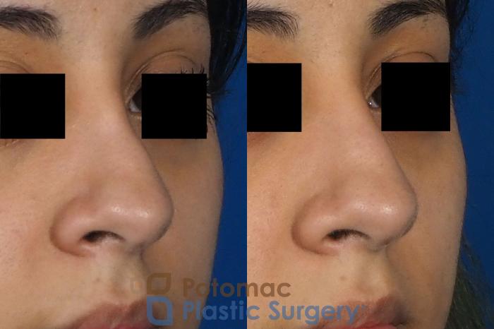 Before & After Rhinoplasty - Cosmetic Case 243 Right Oblique View #2 View in Washington DC & Arlington , DC