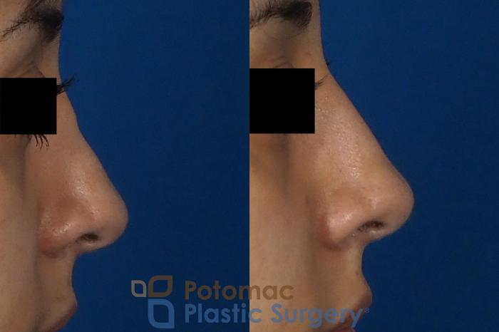 Before & After Rhinoplasty - Cosmetic Case 243 Right Side View in Washington DC & Arlington , DC