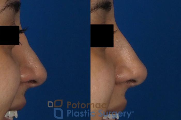 Before & After Rhinoplasty - Cosmetic Case 243 Right Side View #2 View in Washington DC & Arlington , DC