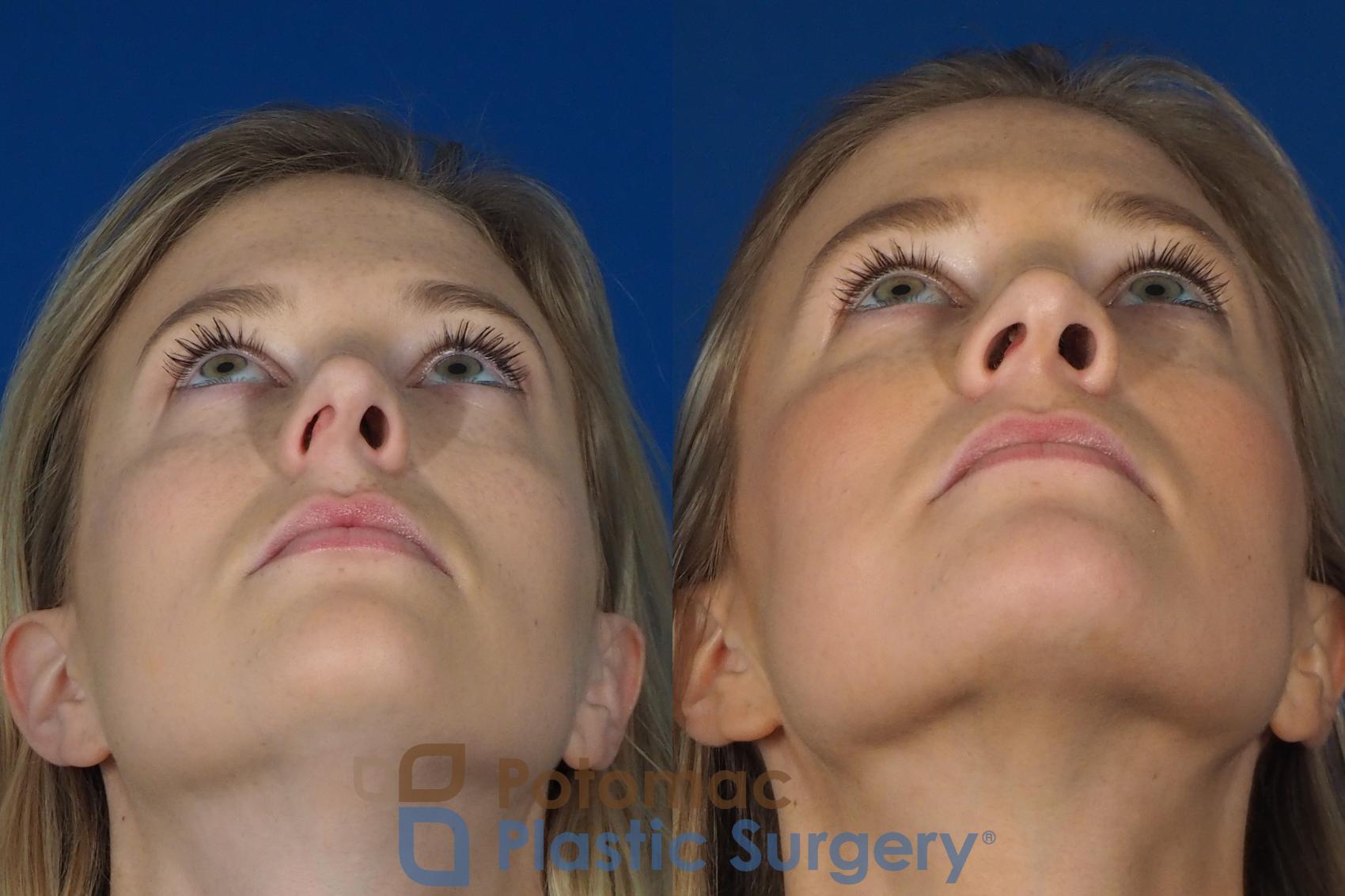 Before & After Rhinoplasty - Cosmetic Case 248 Bottom View in Washington, DC