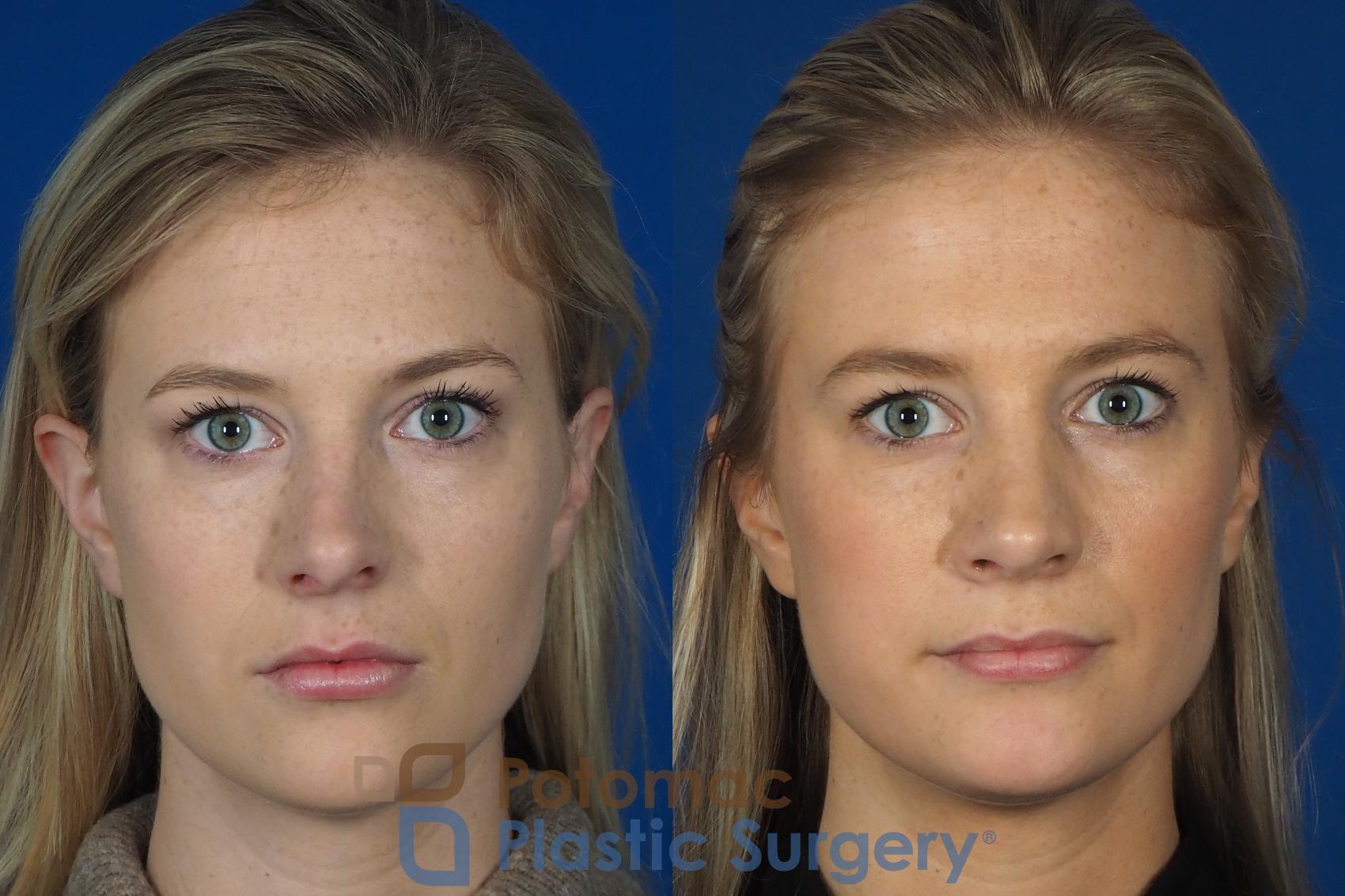 Before & After Rhinoplasty - Cosmetic Case 248 Front View in Washington, DC