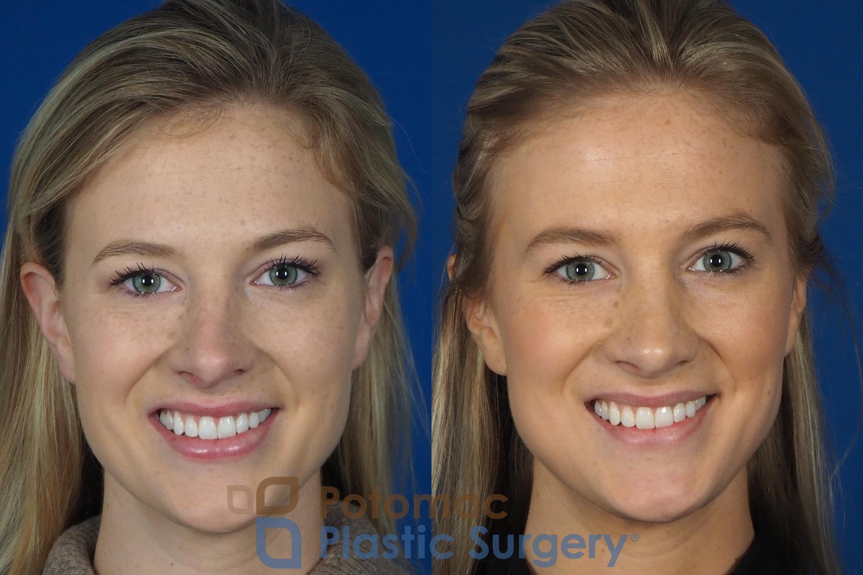 Before & After Rhinoplasty - Cosmetic Case 248 Front - Smiling View in Washington, DC