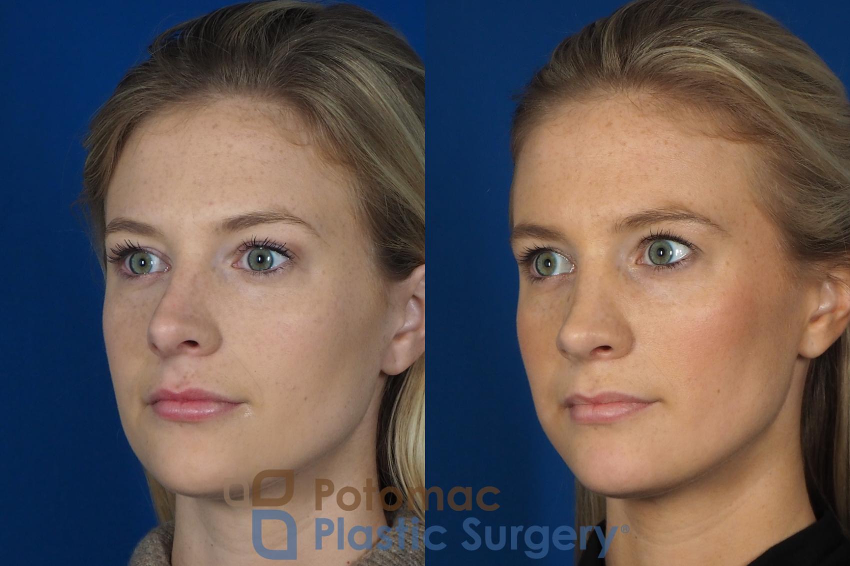 Before & After Rhinoplasty - Cosmetic Case 248 Left Oblique View in Washington, DC