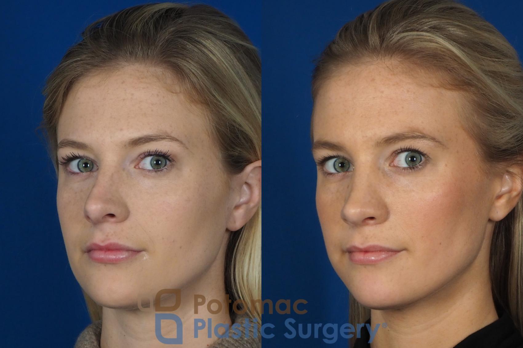 Before & After Rhinoplasty - Cosmetic Case 248 Left Oblique View #2 View in Washington, DC