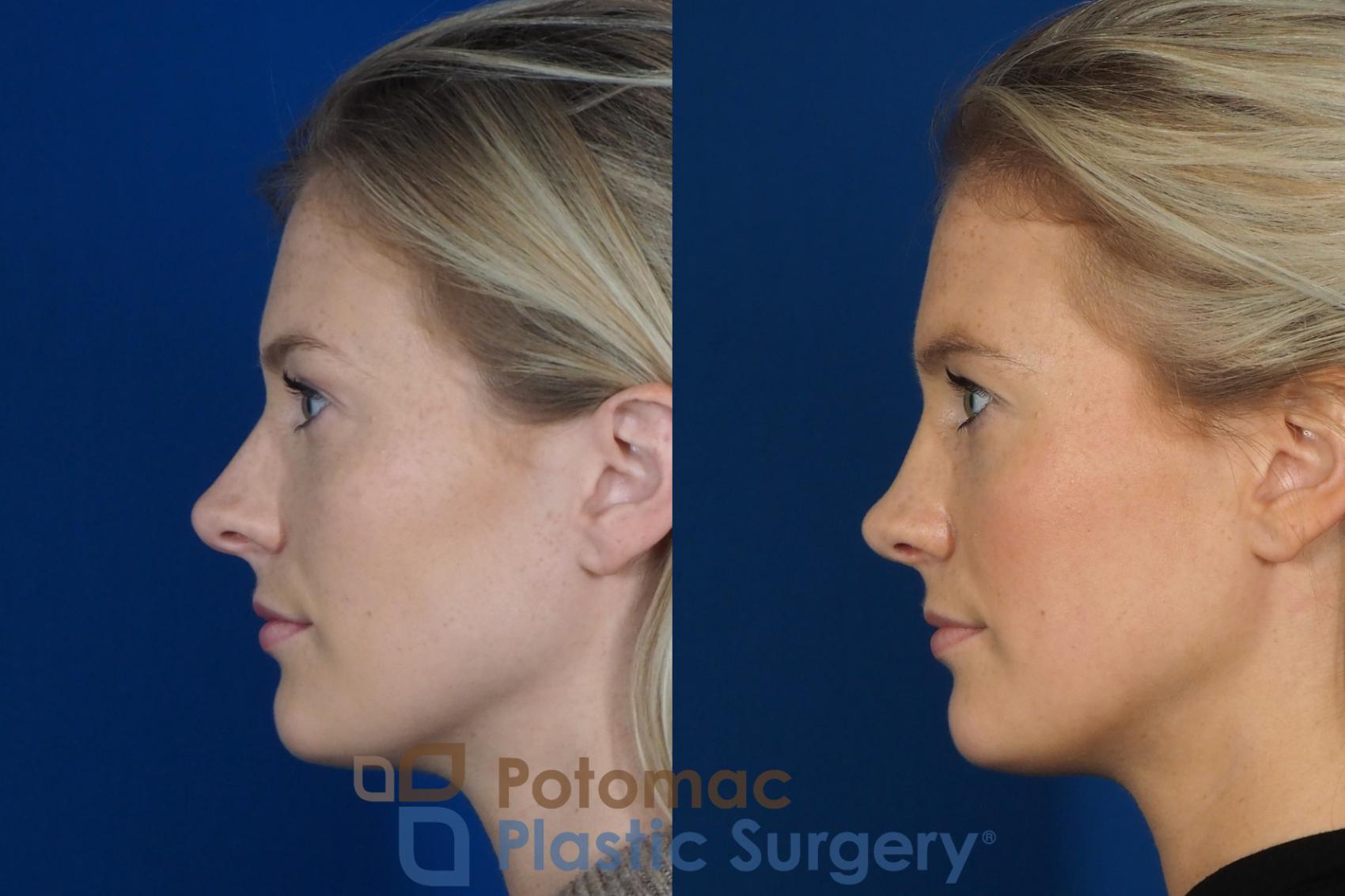 Before & After Rhinoplasty - Cosmetic Case 248 Left Side View in Washington, DC