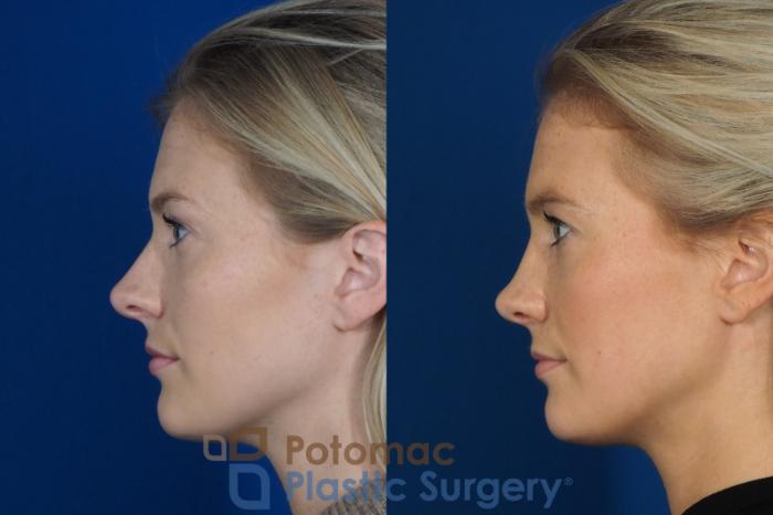 Before & After Rhinoplasty - Cosmetic Case 248 Left Side View in Washington DC & Arlington , DC