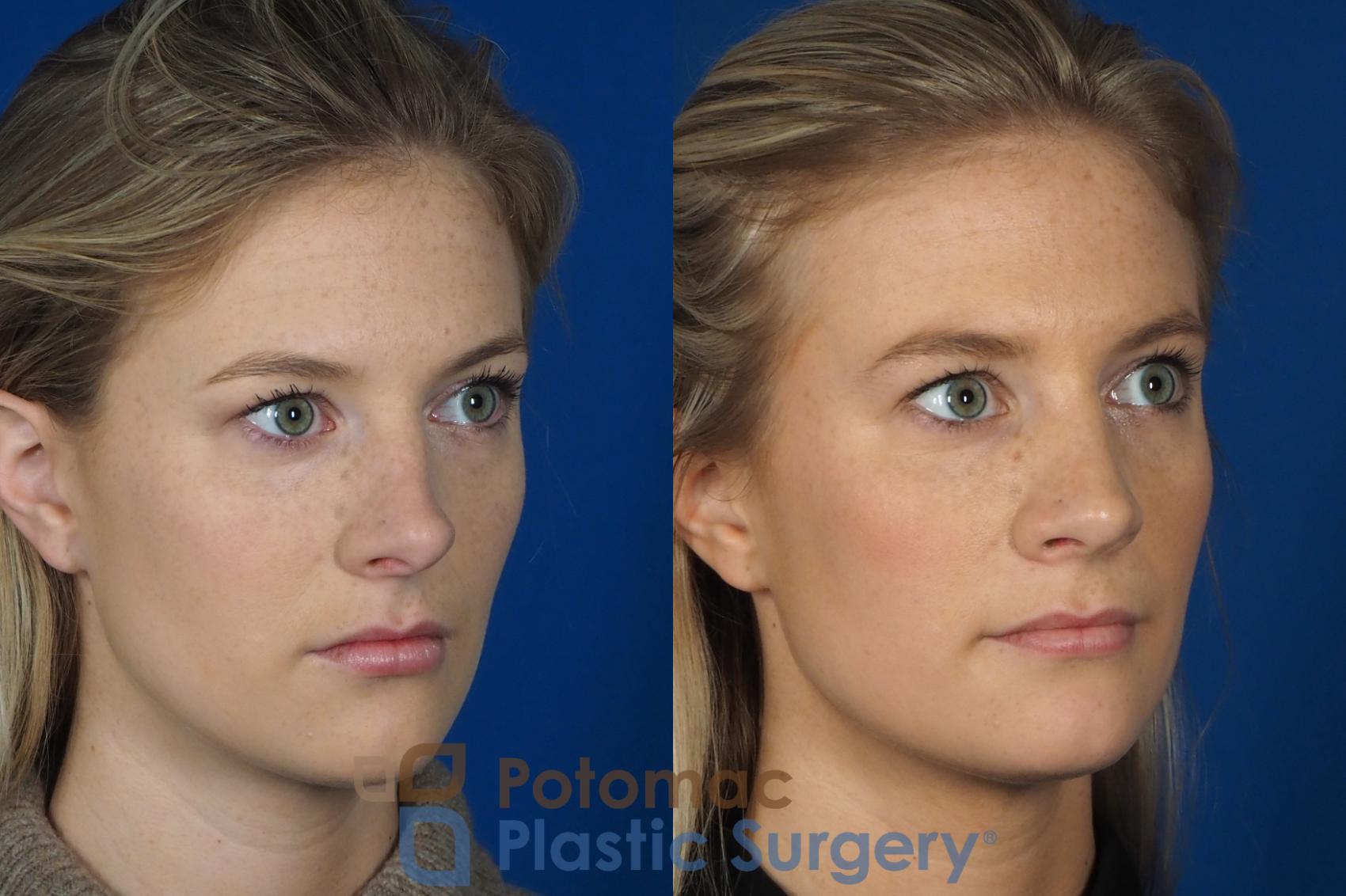 Before & After Rhinoplasty - Cosmetic Case 248 Right Oblique View in Washington, DC