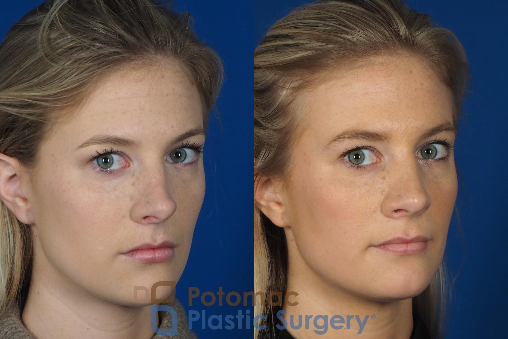 Before & After Rhinoplasty - Cosmetic Case 248 Right Oblique View #2 View in Washington, DC